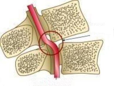 Vail artery syndrome
