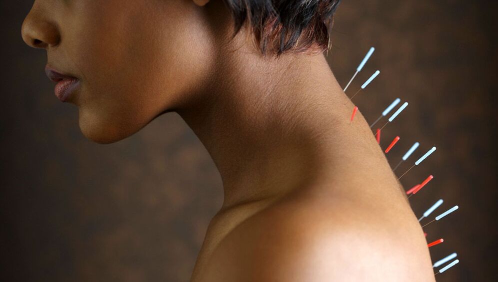 การฝังเข็มด้วยการผ่าตัด osteochondrosis ปากมดลูก