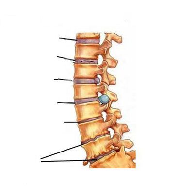การพัฒนา osteochondrosis อย่างไร