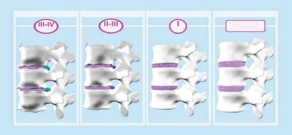 ขั้นตอนของ osteochondrosis ปากมดลูก