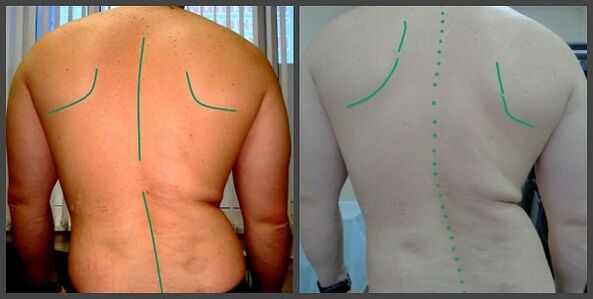 ความโค้งของกระดูกสันหลังกับ osteochondrosis