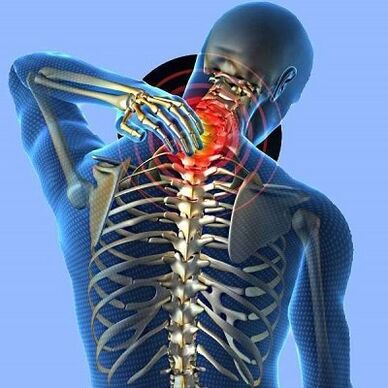อาการปวดคอกับ osteochondrosis ปากมดลูก