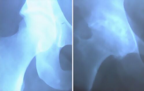 Scum of arthrosis ของข้อเข่า