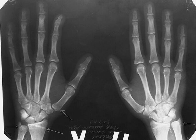 เอ็กซ์เรย์เพื่อปวดข้อของนิ้วมือ