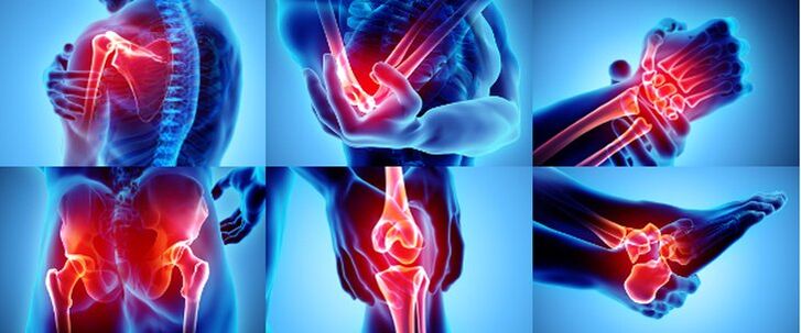 ข้อต่ออักเสบ