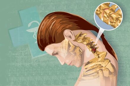 อาการสะท้อนของ osteochondrosis